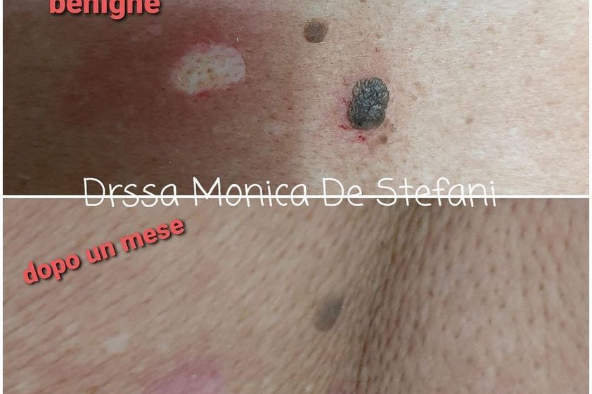 Verruche prima e dopo - 827417