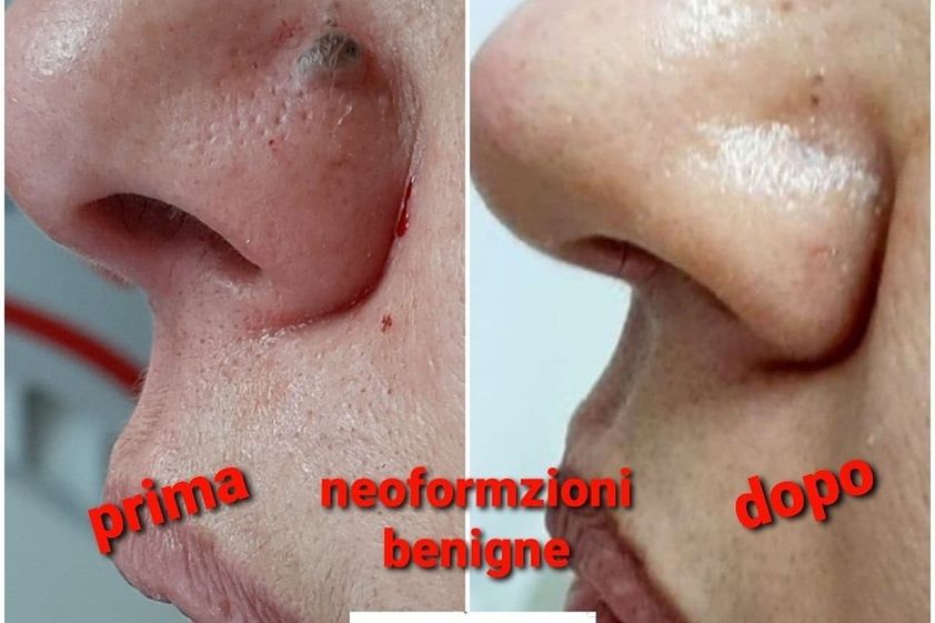 Verruche prima e dopo - 827427