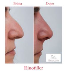 Rinofiller - Studio medico Monica De Stefani