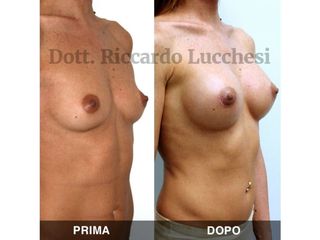 Mastoplastica additiva prima e dopo
