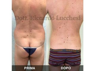 Liposcultura prima e dopo