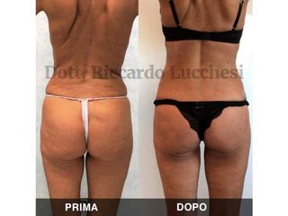 Liposcultura