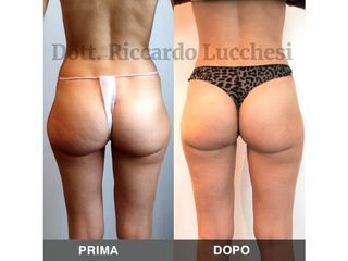 Liposcultura prima e dopo