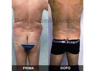 Liposcultura prima e dopo