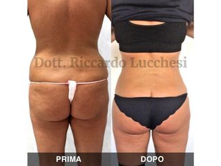 Liposcultura prima e dopo