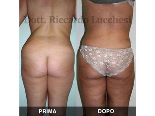 Liposcultura prima e dopo