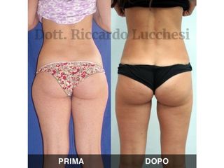 Liposcultura prima e dopo