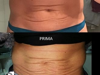 Needling prima e dopo - 766160