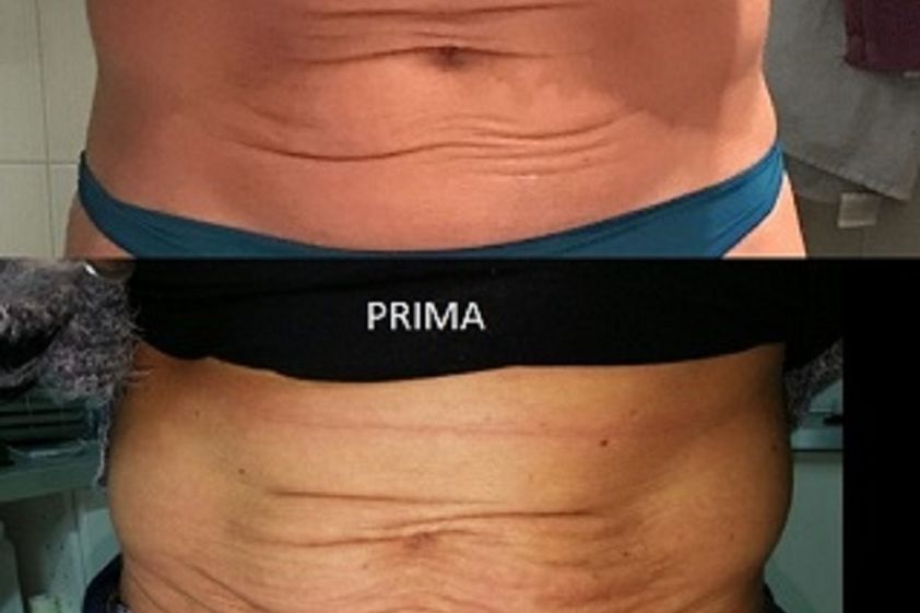 Needling prima e dopo - 766160