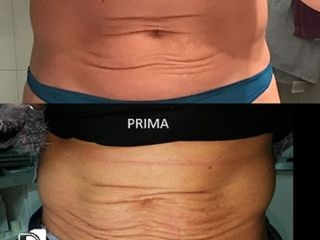 Needling prima dopo