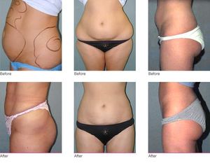 Liposcultura prima e dopo