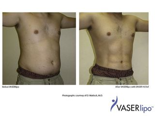 Laserlipolisi prima e dopo