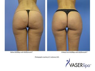 Laserlipolisi prima e dopo