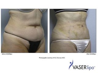 Laserlipolisi prima e dopo