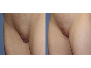 Labioplastica prima e dopo