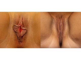 Labioplastica prima e dopo
