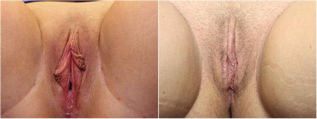 Labioplastica - Dott. Nicola Catania