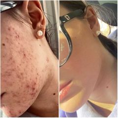 acne prima e dopo - Tuamedica