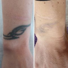tatuaggio Sabrina prima e dopo - Tuamedica