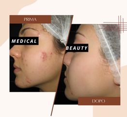 Acne - Dott.ssa Sonia Petruzzo-Medical Beauty Clinic