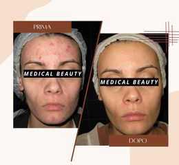 Acne - Dott.ssa Sonia Petruzzo-Medical Beauty Clinic
