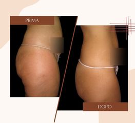 Cellulite - Dott.ssa Sonia Petruzzo-Medical Beauty Clinic