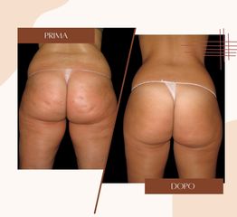 Cellulite - Dott.ssa Sonia Petruzzo-Medical Beauty Clinic