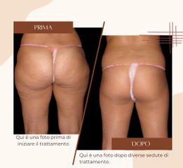 Cellulite - Dott.ssa Sonia Petruzzo-Medical Beauty Clinic