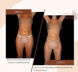 Liposuzione - Dott.ssa Sonia Petruzzo-Medical Beauty Clinic