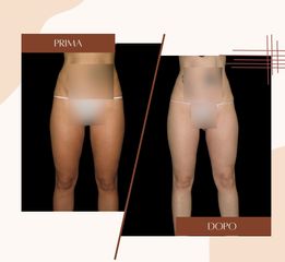 Liposuzione - Dott.ssa Sonia Petruzzo-Medical Beauty Clinic