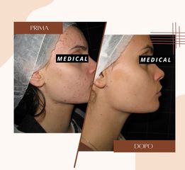  Acne - Dott.ssa Sonia Petruzzo-Medical Beauty Clinic