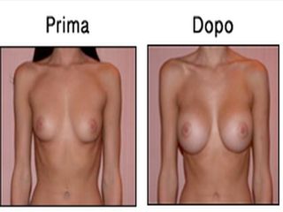mastoplastica additiva prima dopo