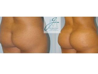 Gluteoplastica prima e dopo