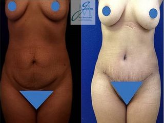 Liposcultura prima e dopo