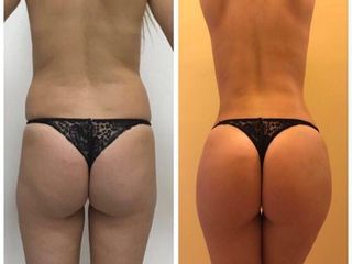 Liposcultura prima e dopo