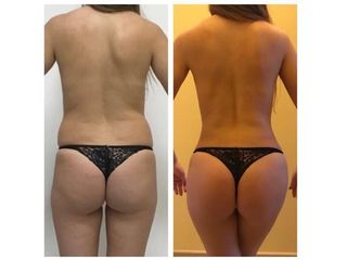 Liposcultura prima e dopo