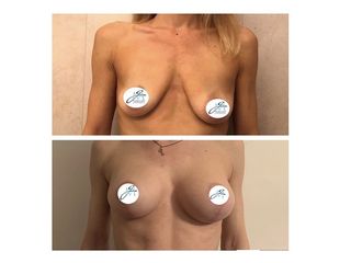 Mastopessi con protesi prima e dopo