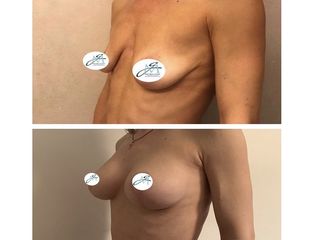 Mastopessi con protesi prima e dopo