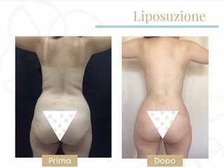 Liposuzione prima e dopo