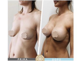 Mastoplastica additiva prima e dopo