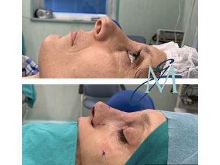 Rinoplastica - Élite Plastic Surgery dottori Marco Galati - Elia Sentine