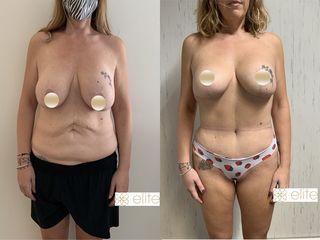 Addominoplastica - Élite Plastic Surgery dottori Marco Galati - Elia Sentine