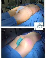 Gluteoplastica - Élite Plastic Surgery dottori Marco Galati - Elia Sentine
