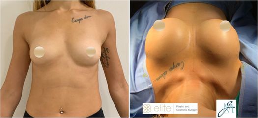 Mastoplastica additiva - Élite Plastic Surgery dottori Marco Galati - Elia Sentine