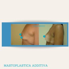 Mastoplastica additiva - Dott. Stefano Toschi