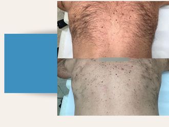 Depilazione laser prima e dopo - 815755