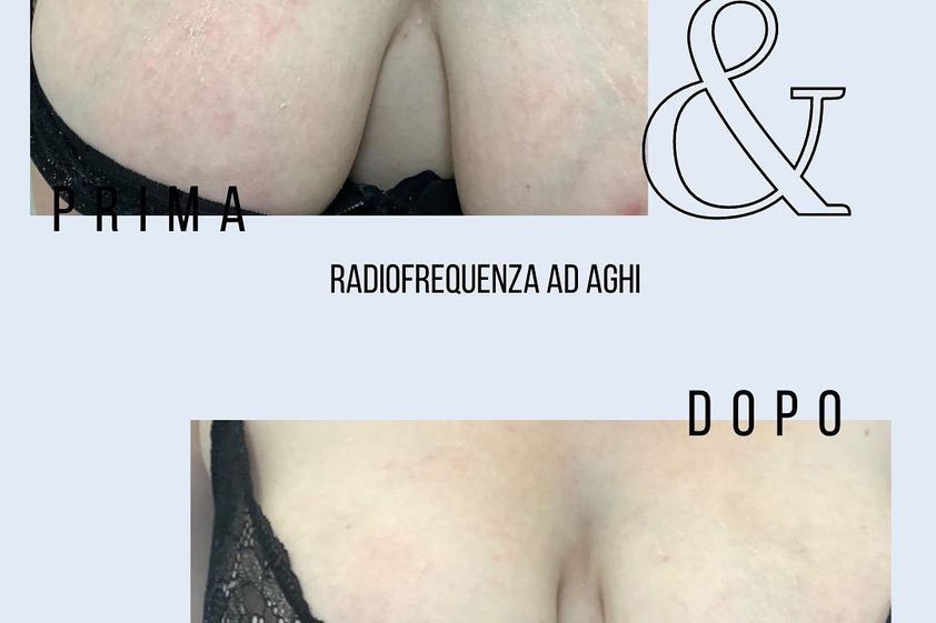 Radiofrequenza prima e dopo - 823403