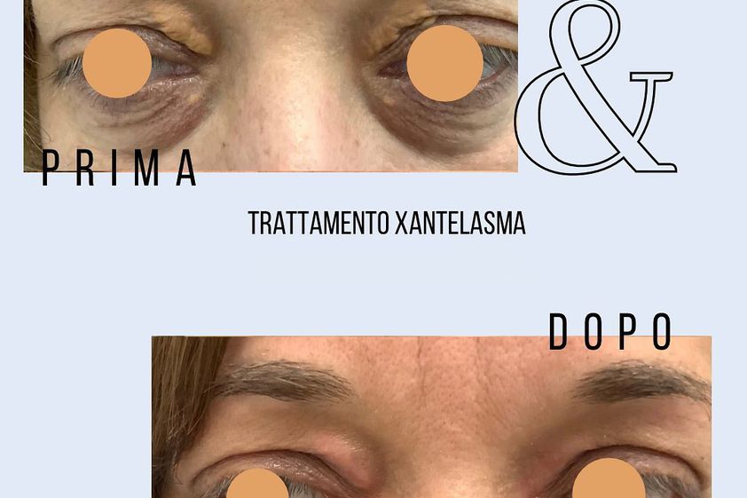 Xantelasmi prima e dopo - 823412