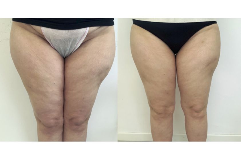 Liposuzione prima e dopo - 825347