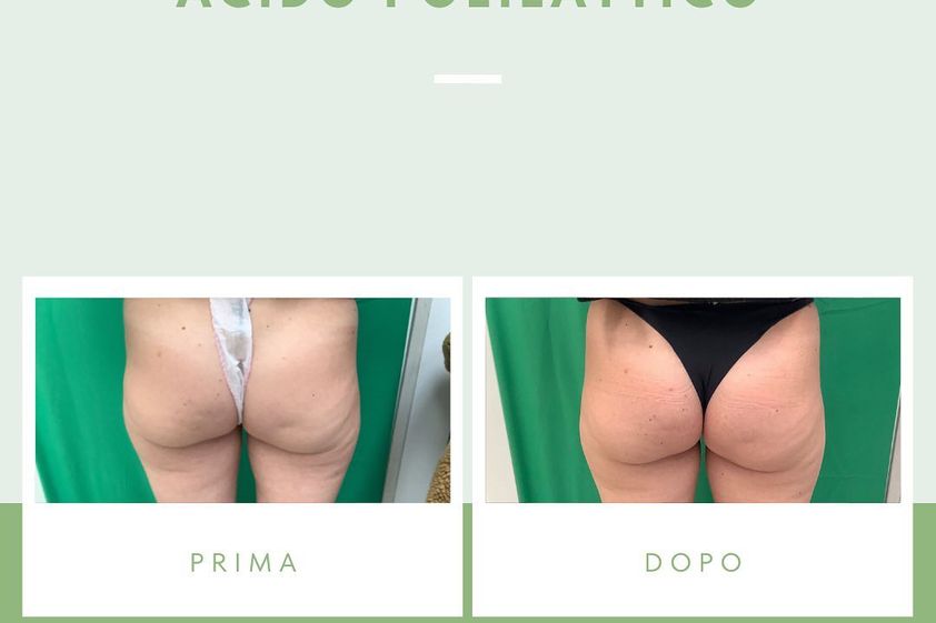 Gluteoplastica prima e dopo - 849974